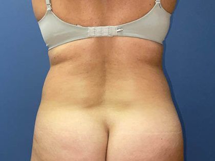 Tummy Tuck Before & After
