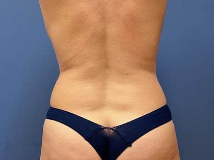 Tummy Tuck Before & After