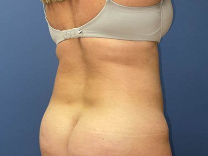 Tummy Tuck Before & After