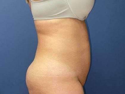 Tummy Tuck Before & After