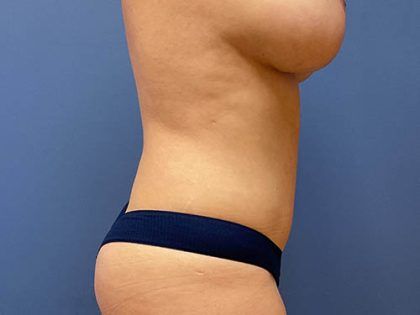 Tummy Tuck Before & After