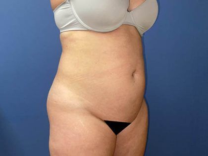 Tummy Tuck Before & After