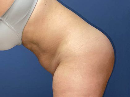 Tummy Tuck Before & After