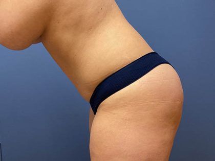 Tummy Tuck Before & After