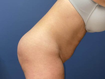 Tummy Tuck Before & After