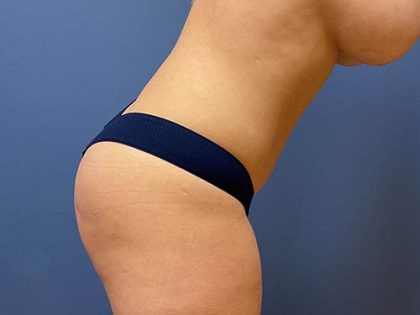 Tummy Tuck Before & After