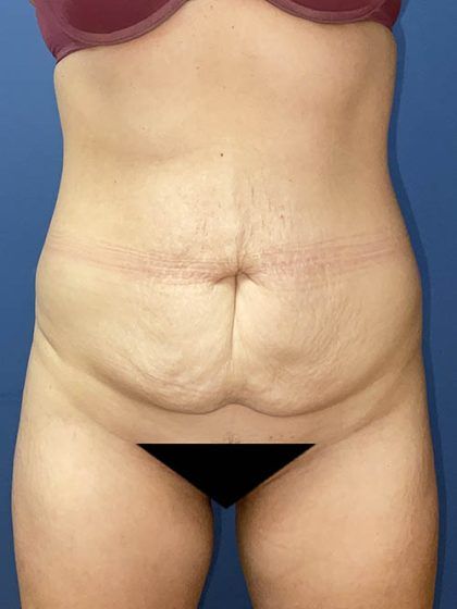 Tummy Tuck Before & After