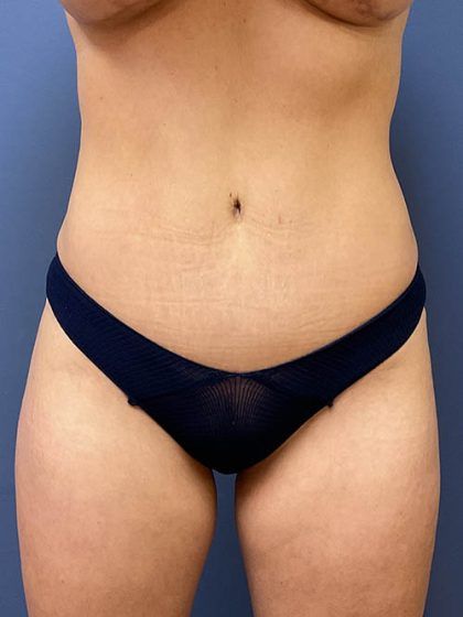 Tummy Tuck Before & After