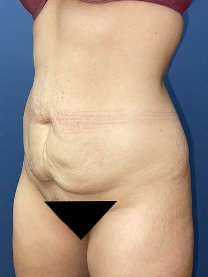 Tummy Tuck Before & After