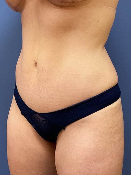 Tummy Tuck Before & After