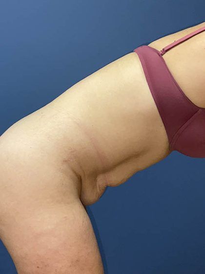 Tummy Tuck Before & After