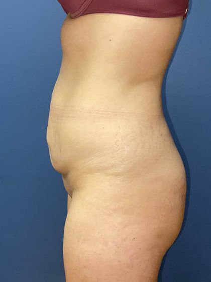 Tummy Tuck Before & After