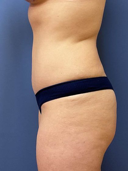 Tummy Tuck Before & After