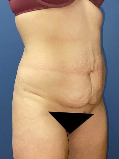 Tummy Tuck Before & After
