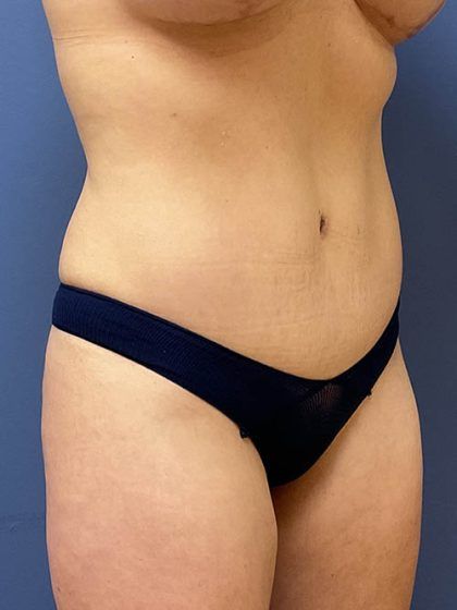 Tummy Tuck Before & After