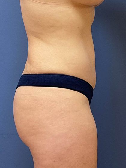 Tummy Tuck Before & After