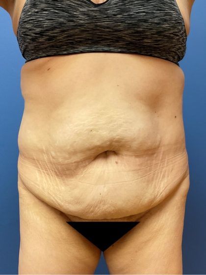 Tummy Tuck Before & After