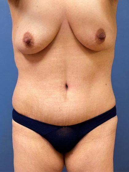 Tummy Tuck Before & After