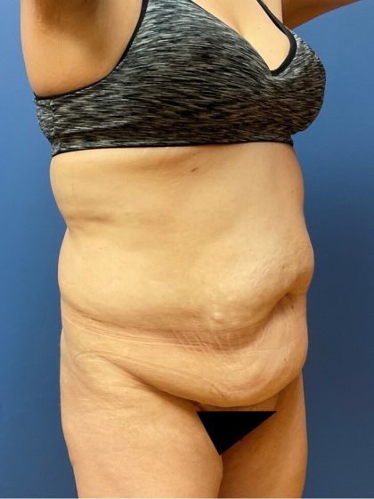 Tummy Tuck Before & After