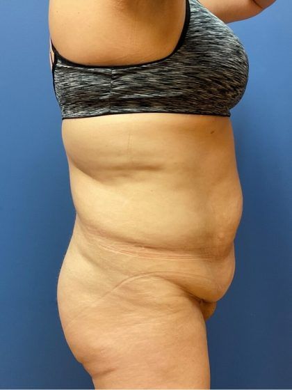 Tummy Tuck Before & After