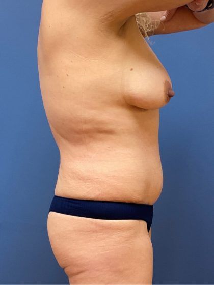 Tummy Tuck Before & After