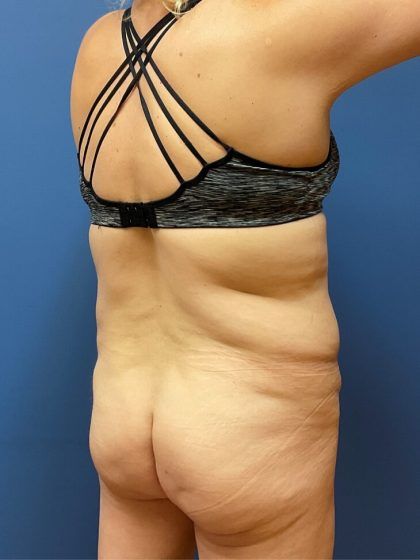 Tummy Tuck Before & After