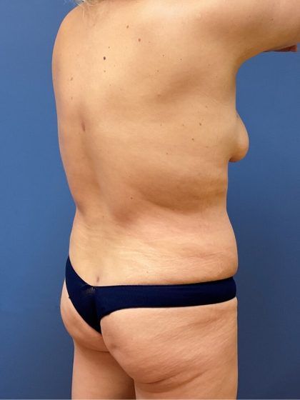 Tummy Tuck Before & After