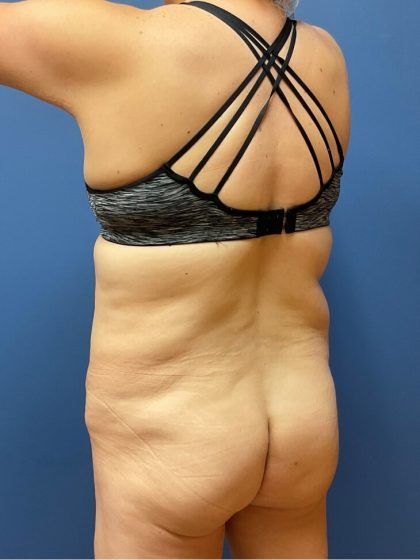 Tummy Tuck Before & After