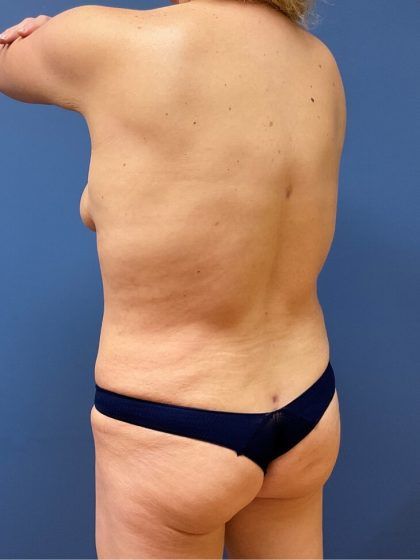 Tummy Tuck Before & After