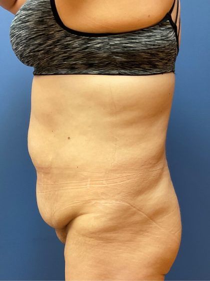 Tummy Tuck Before & After