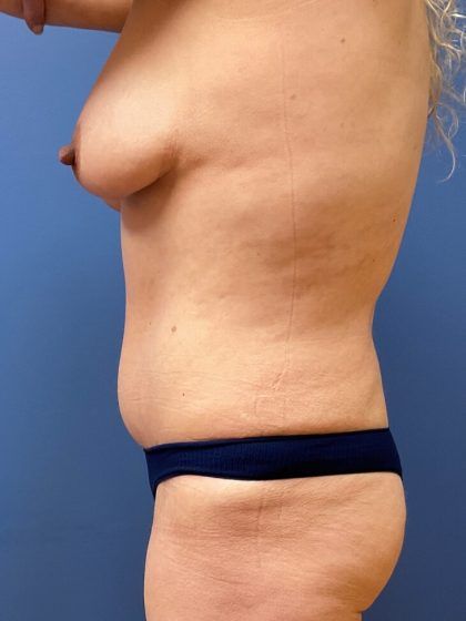 Tummy Tuck Before & After