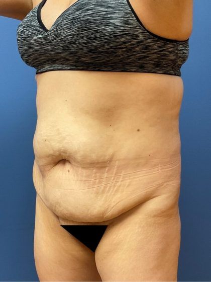 Tummy Tuck Before & After