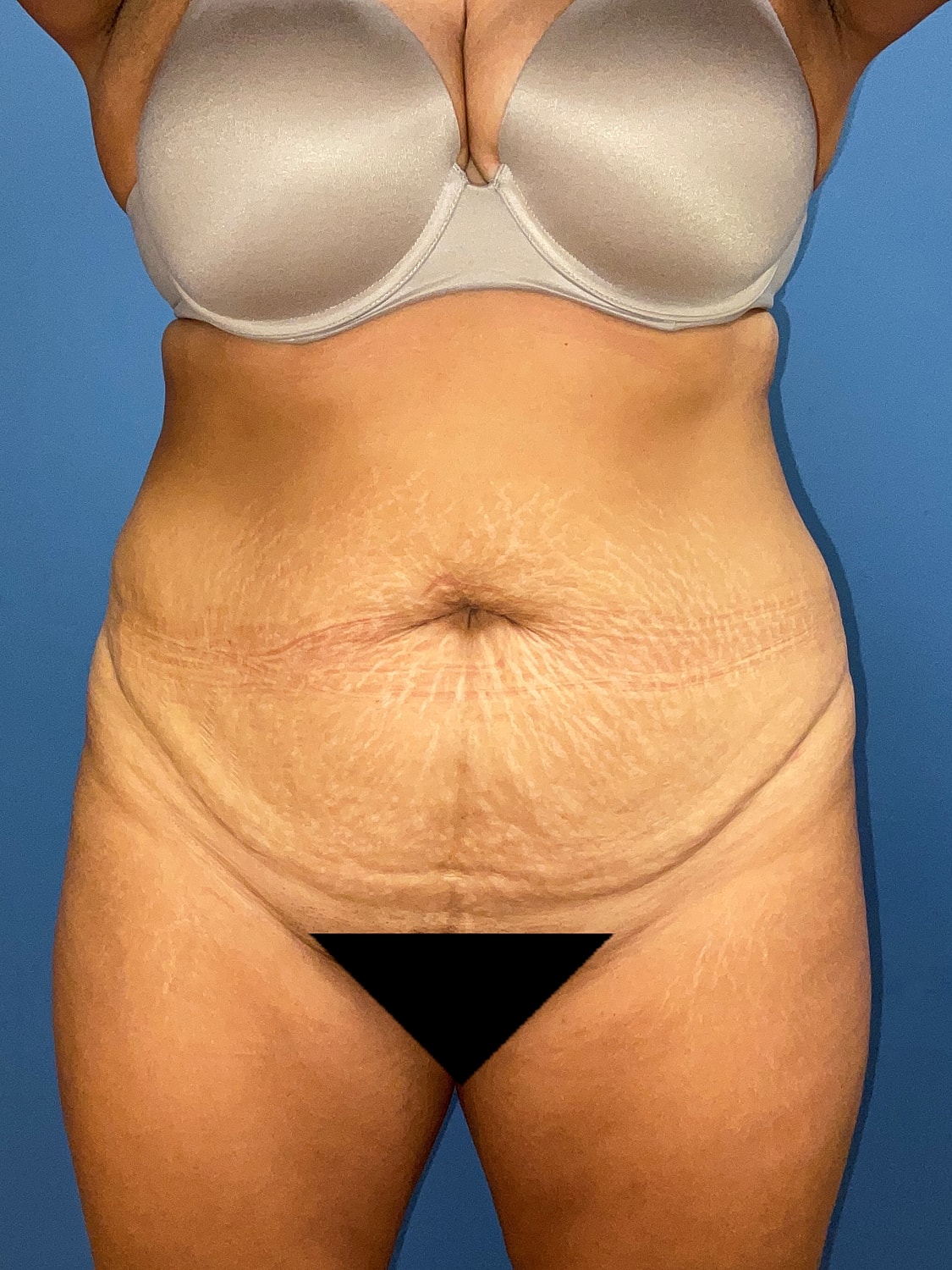 Tummy Tuck Before & After