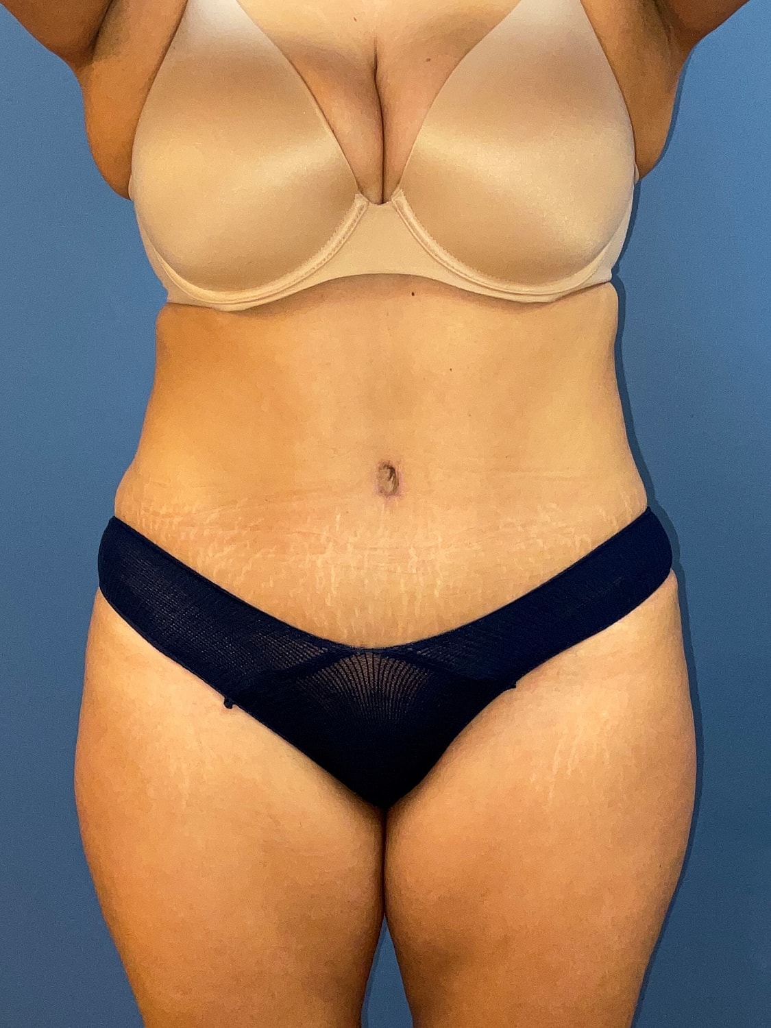 Tummy Tuck Before & After