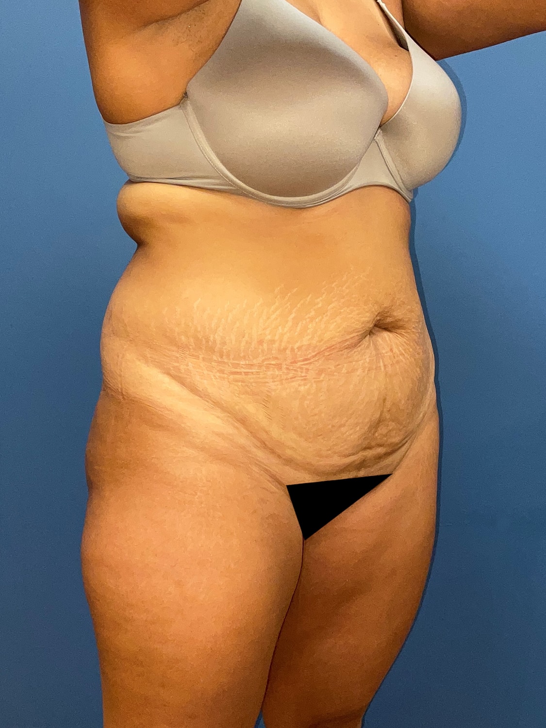 Tummy Tuck Before & After