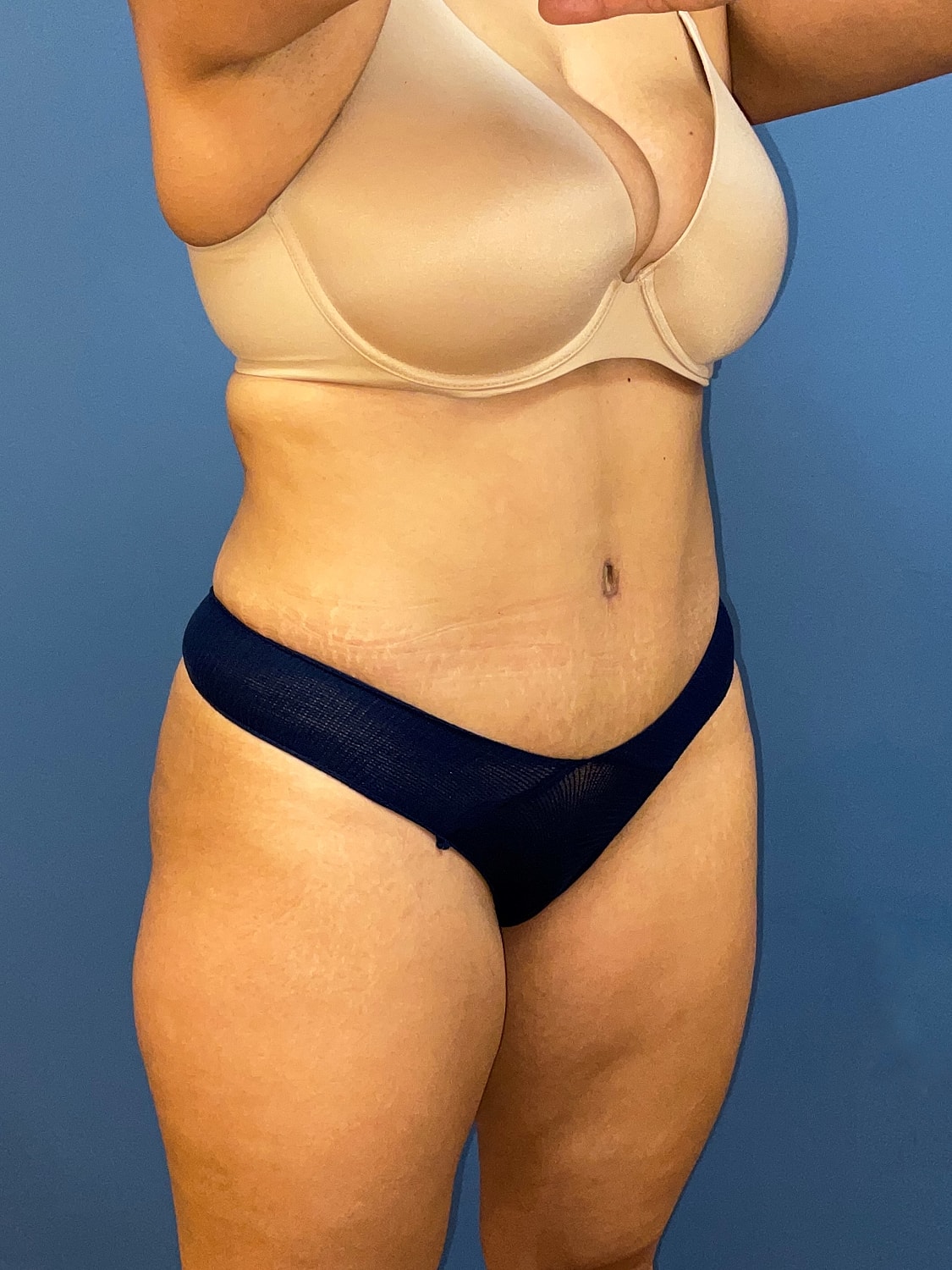 Tummy Tuck Before & After