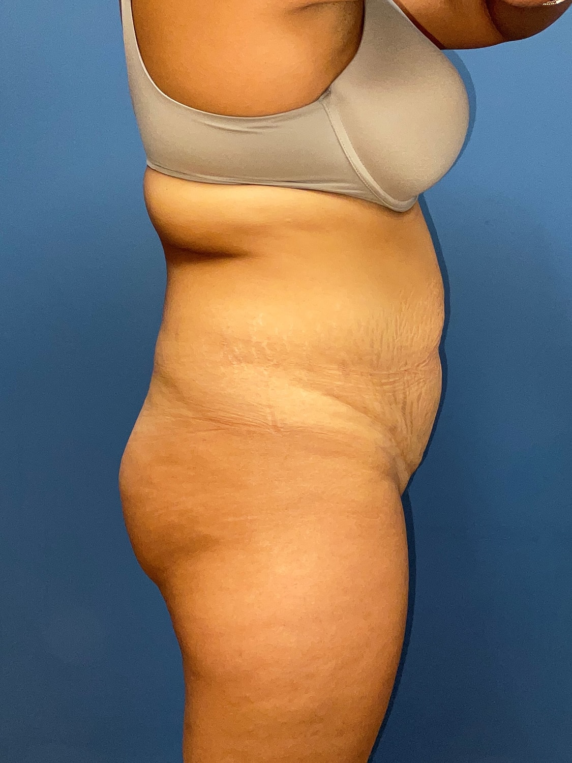 Tummy Tuck Before & After