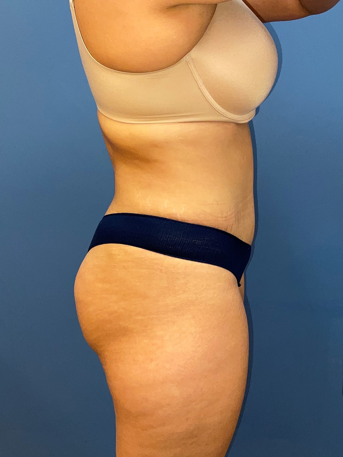 Tummy Tuck Before & After