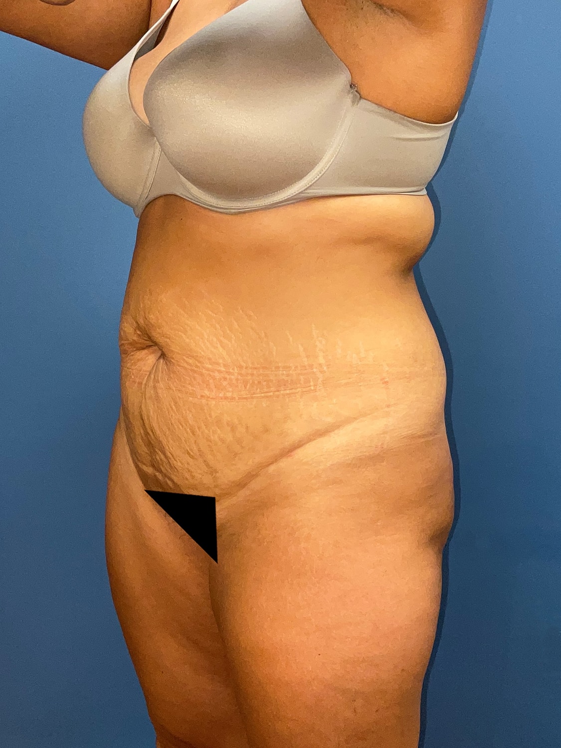 Tummy Tuck Before & After