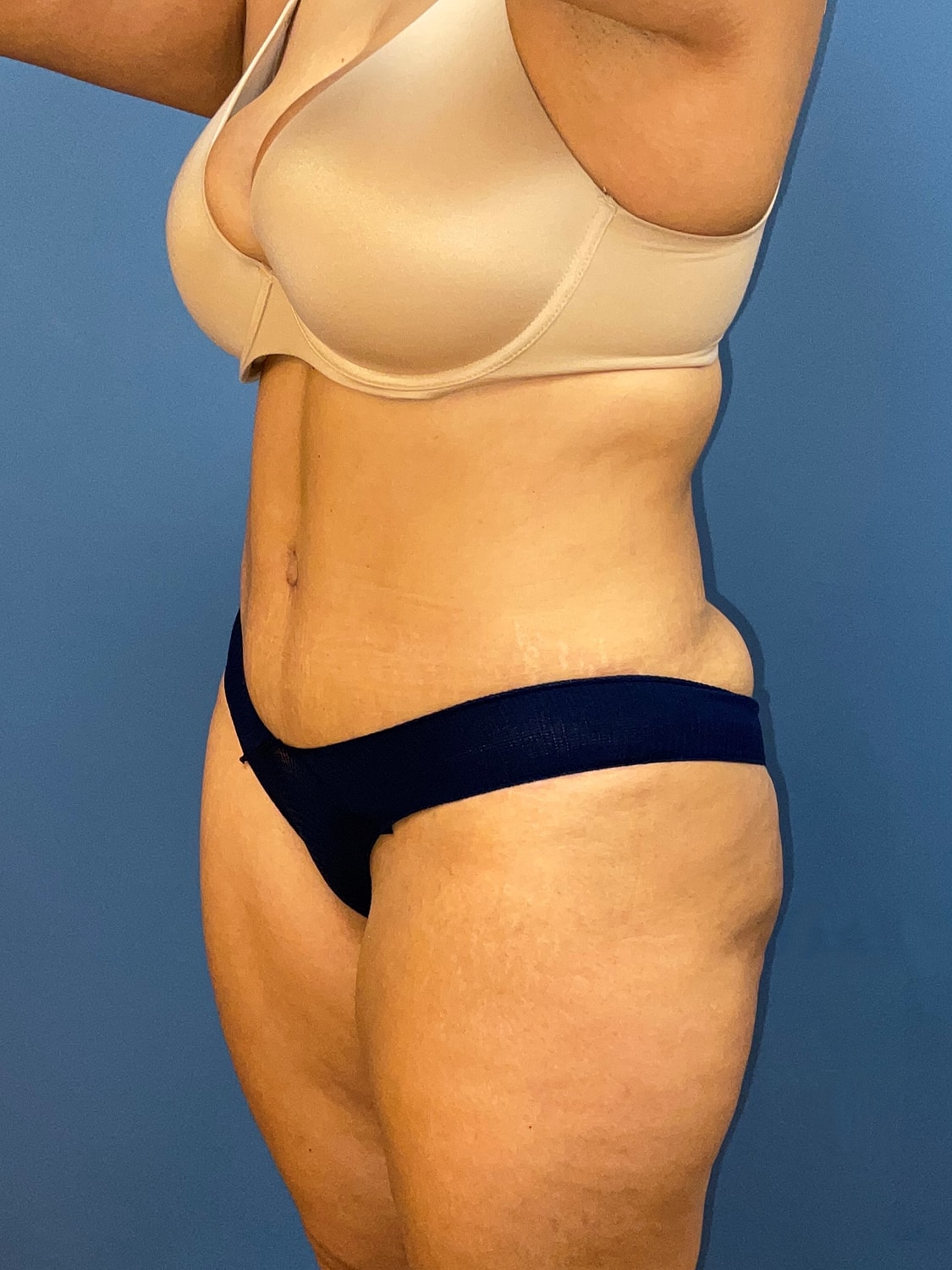 Tummy Tuck Before & After