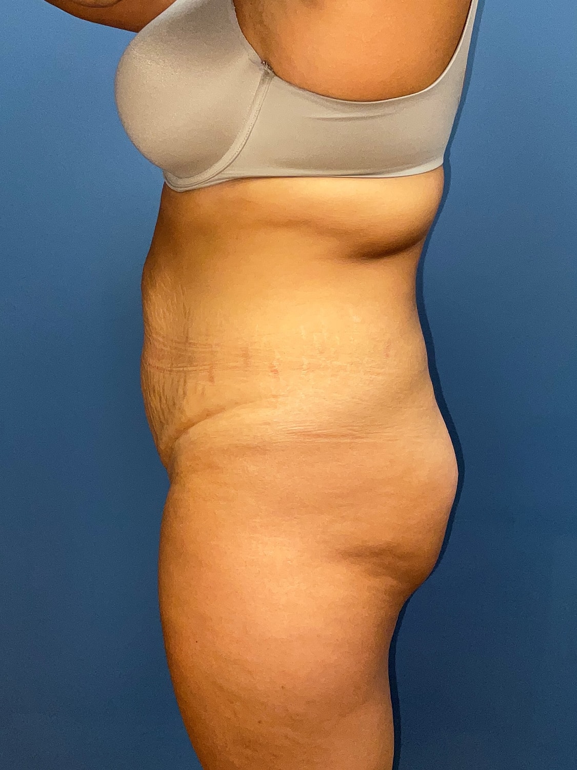 Tummy Tuck Before & After