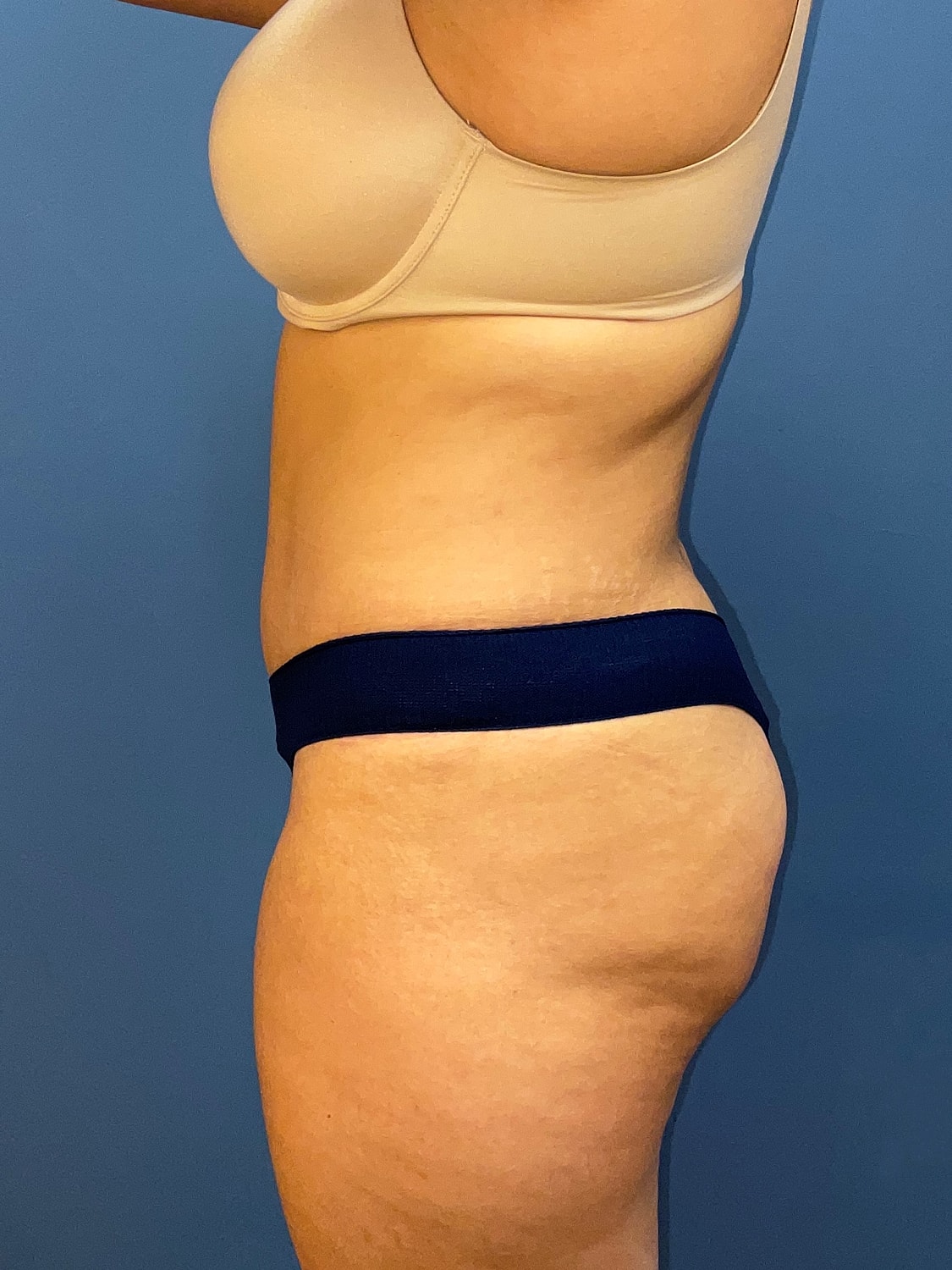 Tummy Tuck Before & After