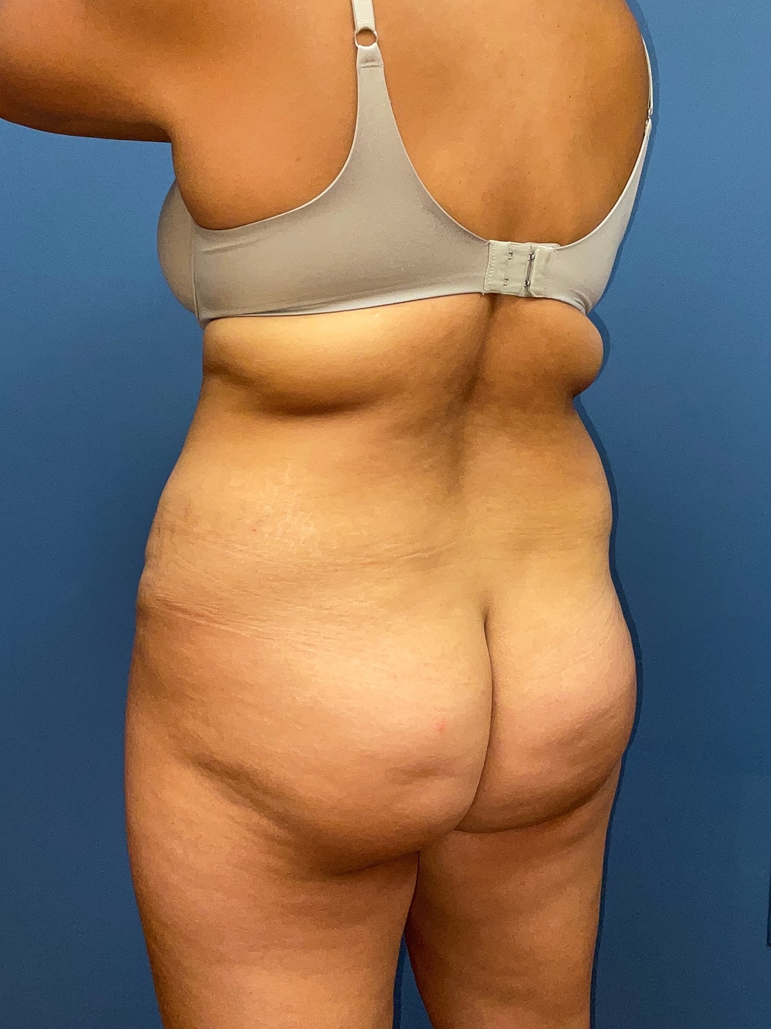 Tummy Tuck Before & After