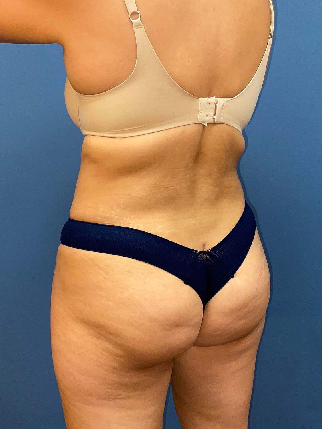 Tummy Tuck Before & After