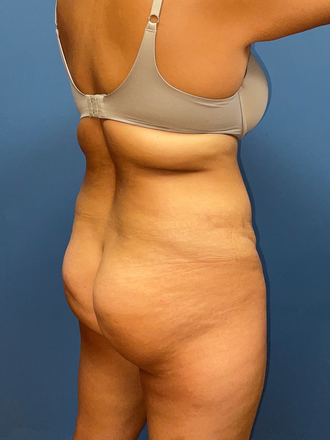 Tummy Tuck Before & After