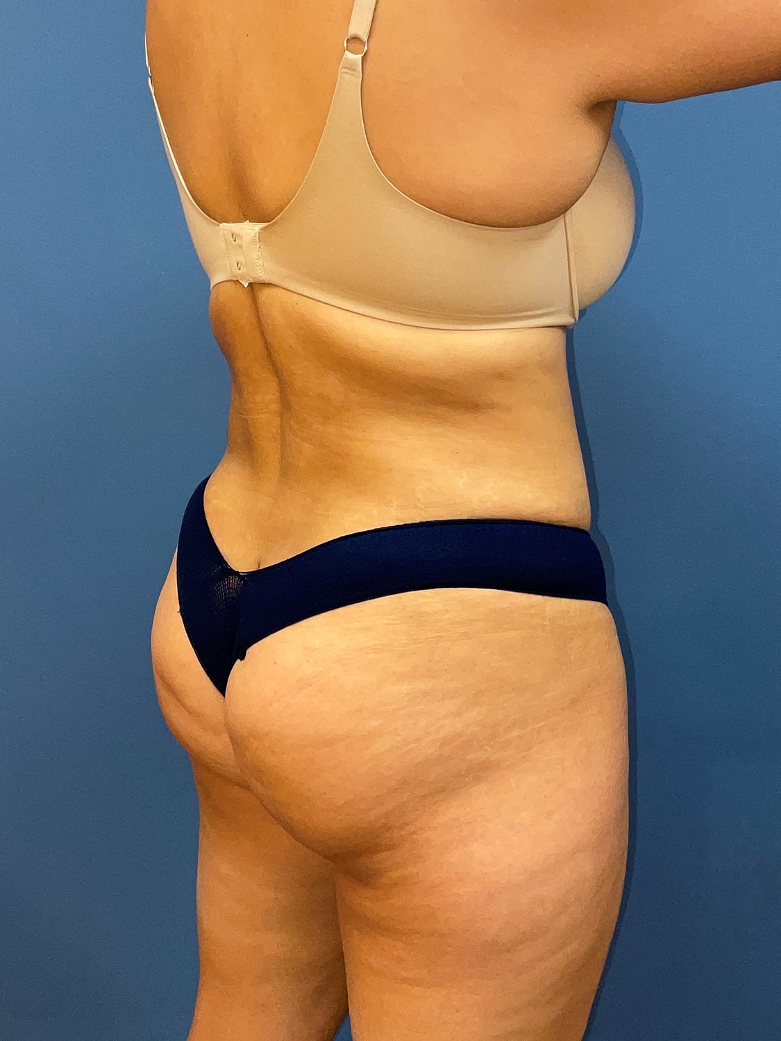 Tummy Tuck Before & After