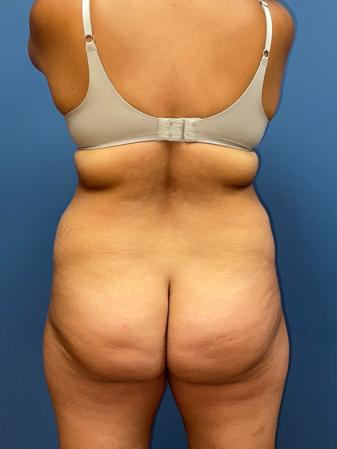 Tummy Tuck Before & After