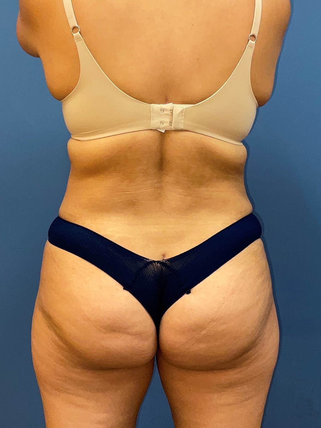 Tummy Tuck Before & After