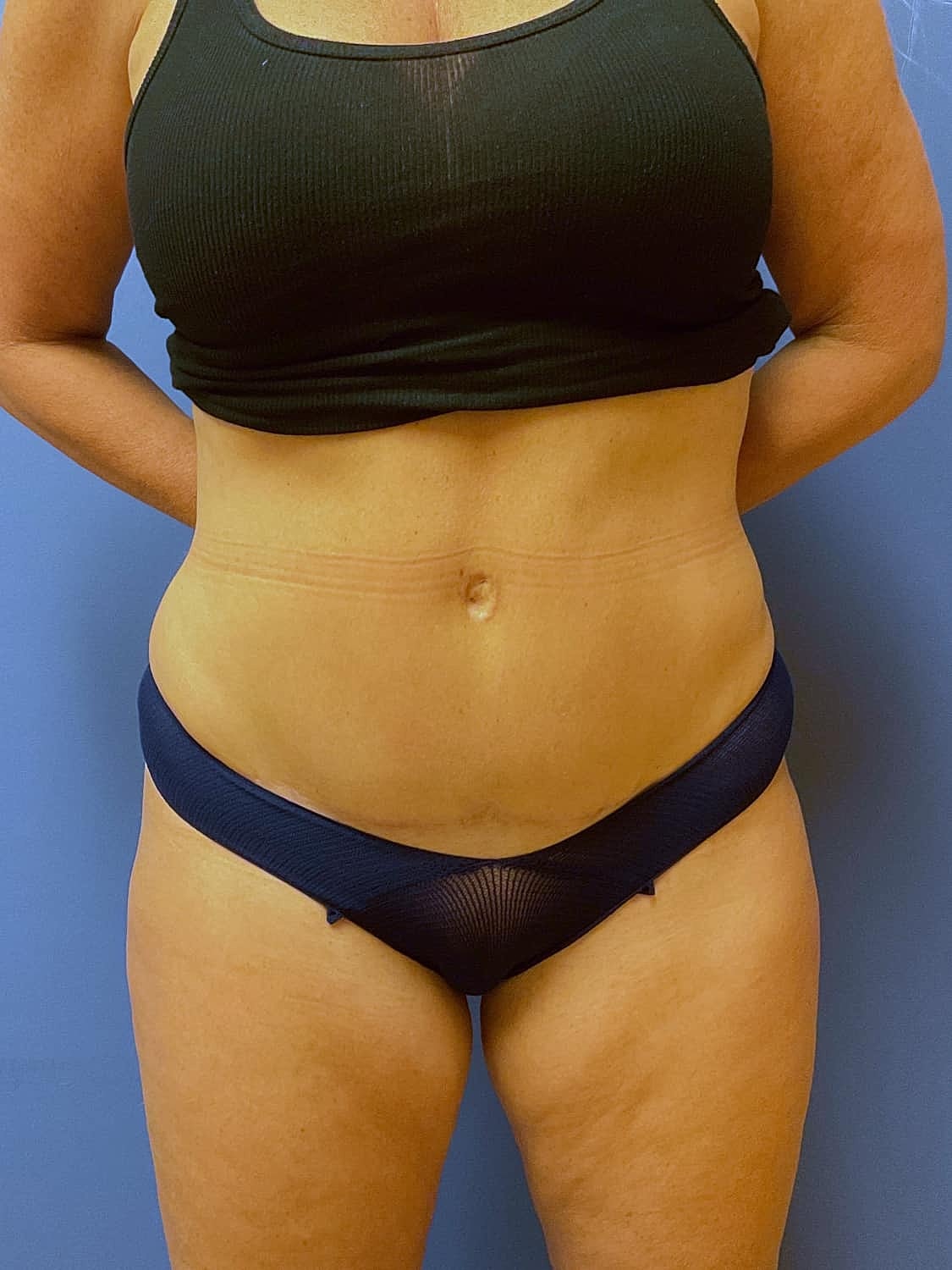 Tummy Tuck Before & After