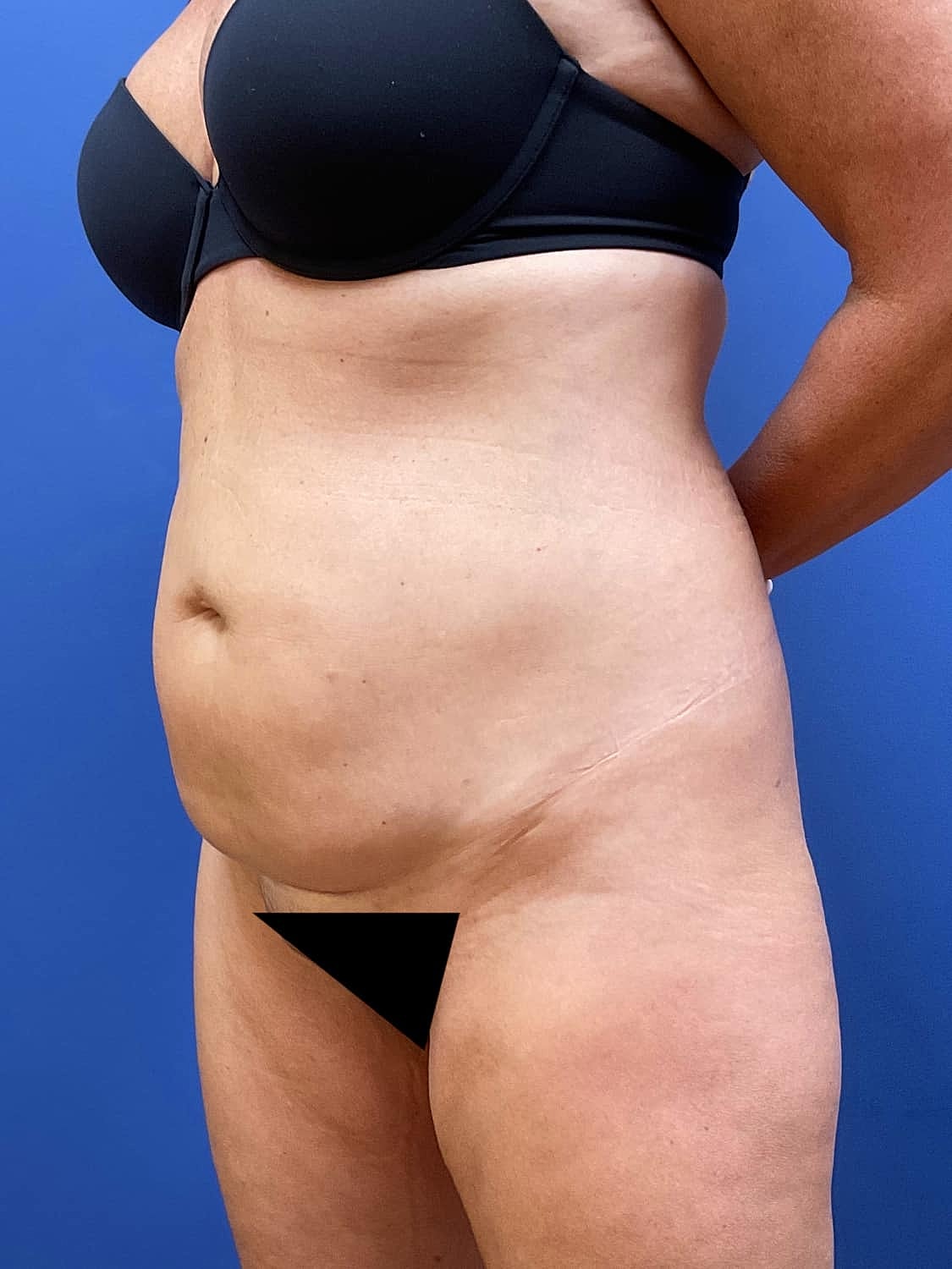 Tummy Tuck Before & After